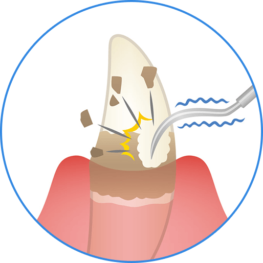 見える部分の歯石を可能な範囲で除去