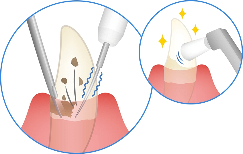 歯茎の下の見えない歯石を④よりもさらに繊細な超音波器具で除去・艶出し研磨